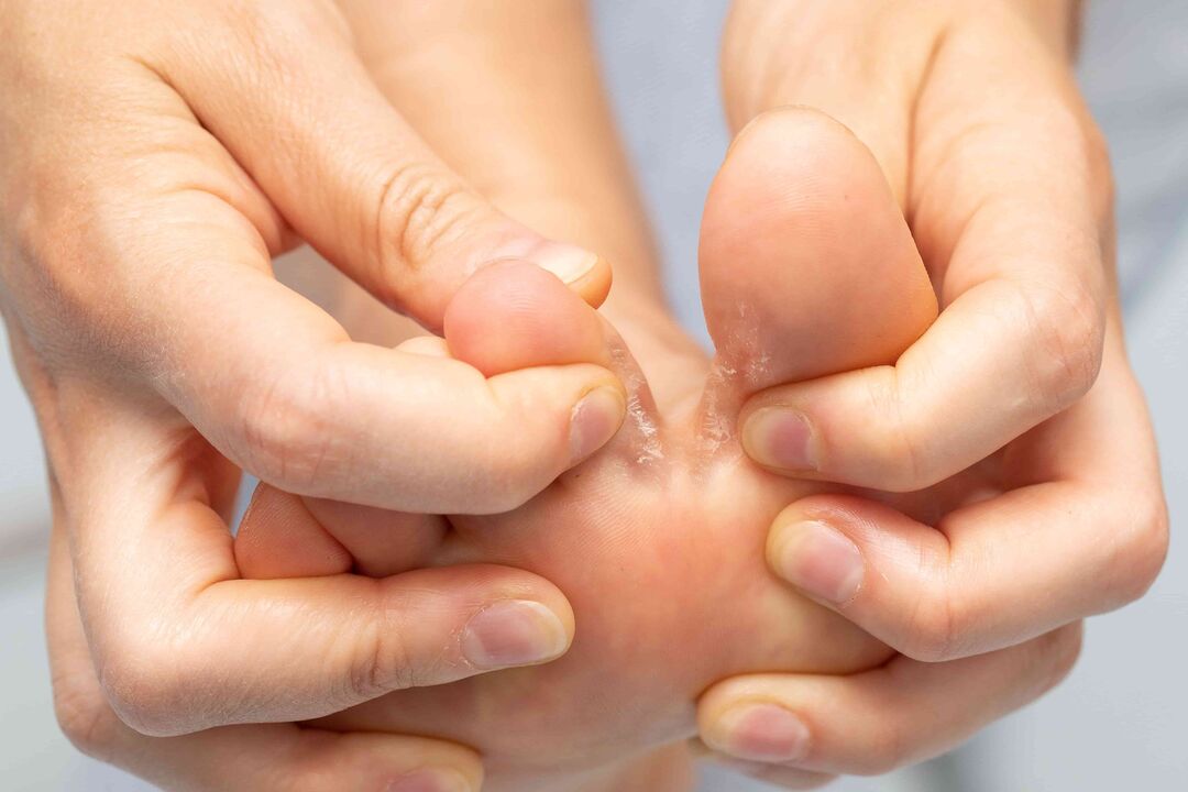 Mushroom between toes and its treatment with the Demyxil cream