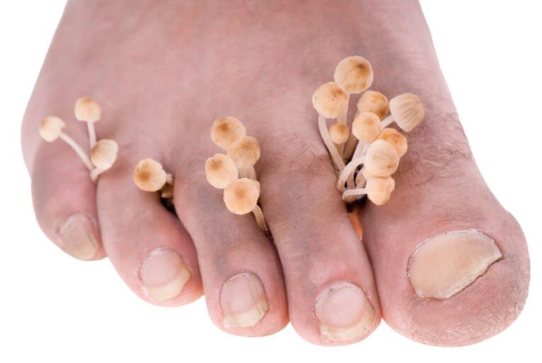 Mushroom on the legs symptoms