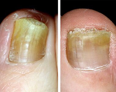 Distal shape of onychomycosis on the legs