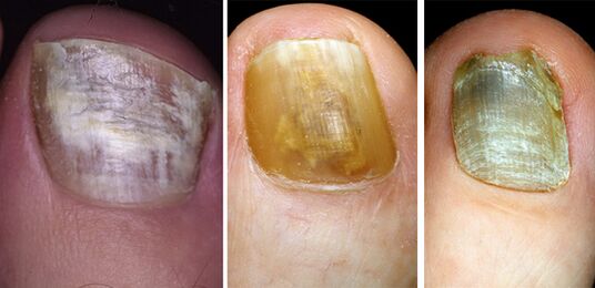 In the photo, a change in color of the nails on the legs with a fungal disease