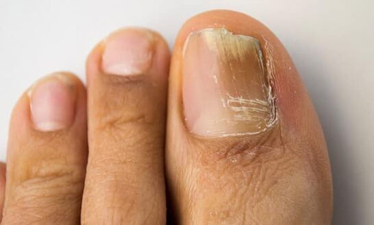 Type of distal lateral damage with onychomycosis on the legs