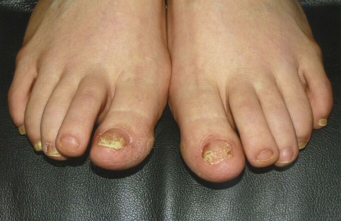 nail fungus
