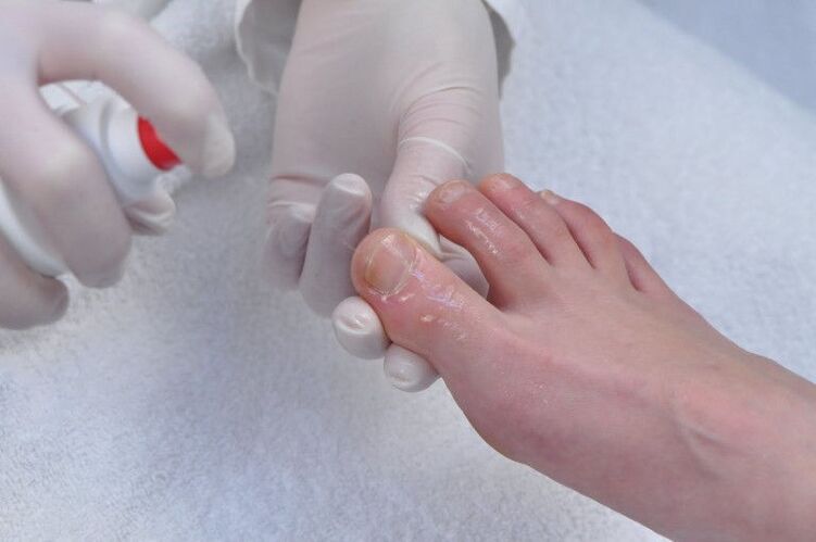 treatment of nail plate for fungal infection